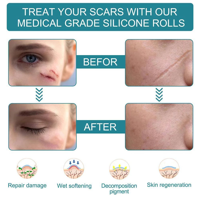 Silicone Scar Sheets