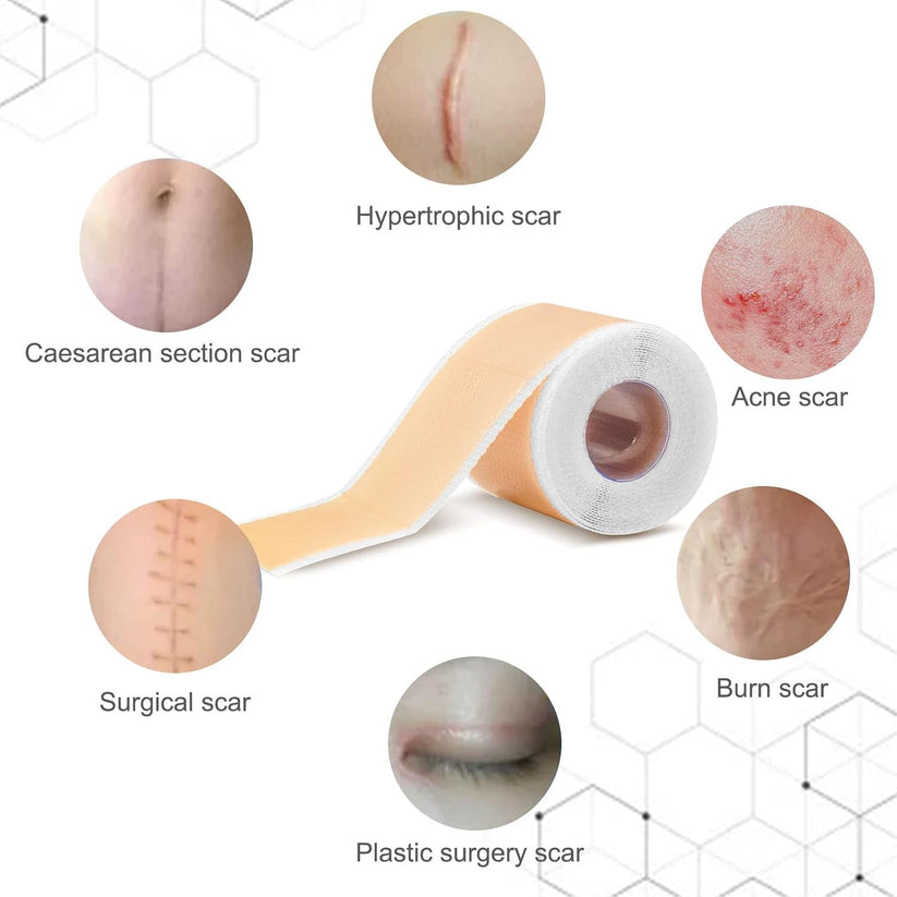 Silicone Scar Sheets