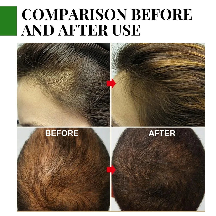 EELHOE Rosemary Hair Growth Essential Oil
