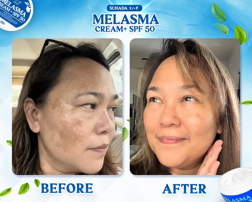 Suhada Japanese Melasma Cream with SPF50