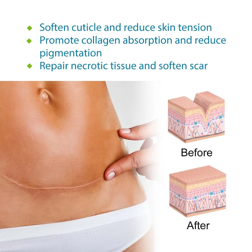 Silicone Scar Sheets