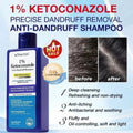 KORMESIC Anti-Dandruff Ketoconazole Shampoo for Scalp Treatment and Oil Control